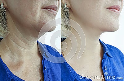 Woman wrinkles face before facelift collage after treatments procedure problem Stock Photo