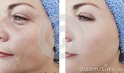 Woman wrinkles face beautician difference before and after treatments Stock Photo