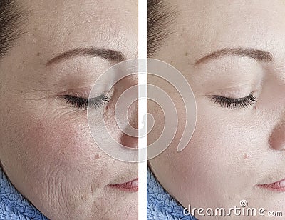 Woman wrinkles skin before and after results regeneration mature treatment cosmetology treatments Stock Photo