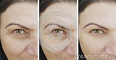 Woman wrinkles skin face lift results collagen removal rejuvenation therapy difference cosmetology before and after treatments Stock Photo