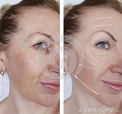 Woman wrinkles skin difference antiaging contours before and after regeneration Stock Photo