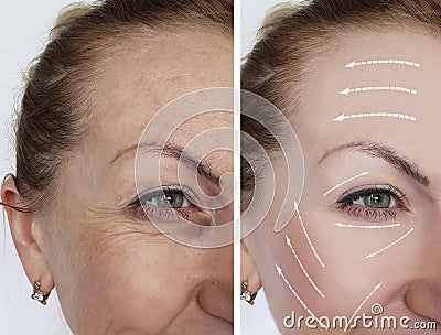 Woman wrinkles skin antiaging collagen before and after regeneration Stock Photo