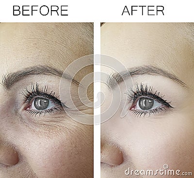 Woman wrinkles before and after treatment treatment anti, aging procedures Stock Photo