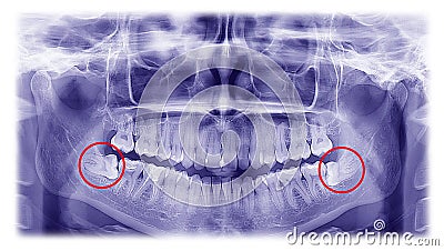 Woman x-ray of the teeth wisdom teeth horizontal pozition Stock Photo