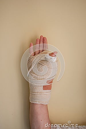 A womans wrist in a heavy cast after a thumb operation Stock Photo