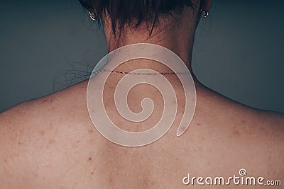 Women posing next to the old black textured wall. slender body of a teenager, covered with moles and pimples. problematic skin bac Stock Photo