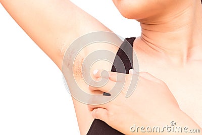 Women problem black armpit on white background for skin care and Stock Photo