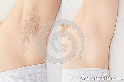Women underarm hair removal. Concept before and after shaving sugar depilation laser Stock Photo