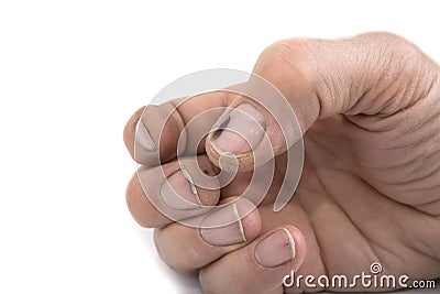 Worker dirty bruised hands and nails on a white background Stock Photo