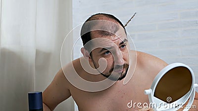 Worrying about Hair  Balding Man in Front of a Mirror Takes Care of  His Hair, Uses a Means for Hair Growth in Case Stock Footage - Video of  loosing, caucasian: 164927366