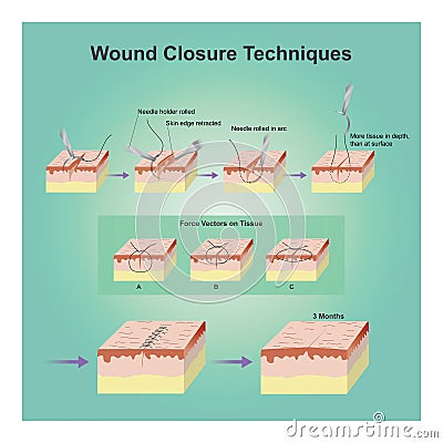 Wound closure techniques. Vector Illustration