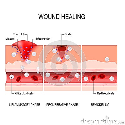 Wound healing process. Tissue injury and inflammation Vector Illustration