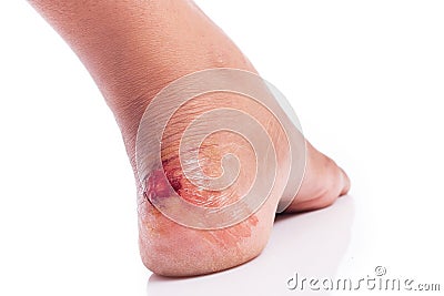 Wound at heel Stock Photo