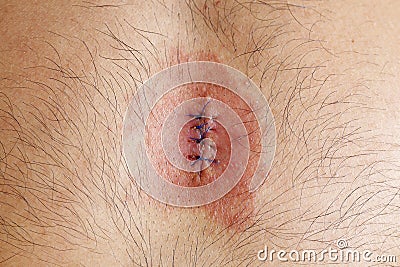 Wound infection Stock Photo