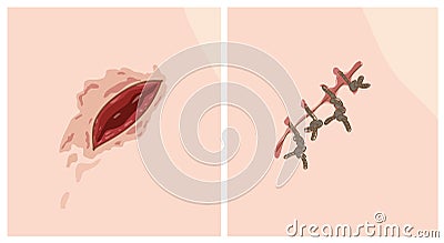 Wound and scar. Vector Illustration