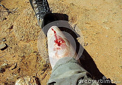 Picture Of Woman Wounded Leg 51