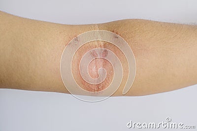 Wounds on arm caused by poisonous insects. Stock Photo