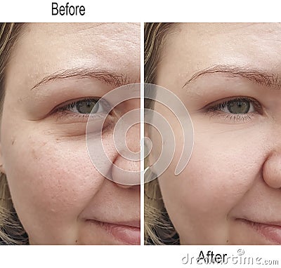 Wrinkle,forehead,skin,cheek,face,eyebrows,lifting women Stock Photo