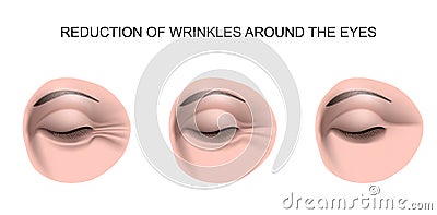 Wrinkles around the eyes Vector Illustration