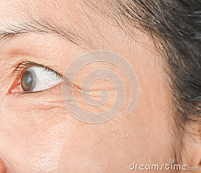Wrinkles around the eyes and skin problems. Stock Photo
