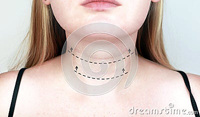 A cosmetologist prepares the patient for surgery: contour plastics of the neck, mesotherapy or botulinum therapy. Wrinkles and Stock Photo