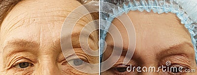 Wrinkles elderly woman face effect collagen hydrating health correction before and after cosmetic procedures, therapy, anti-aging Stock Photo