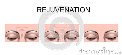 Wrinkles on the forehead. rejuvenation. plastic surgery Vector Illustration