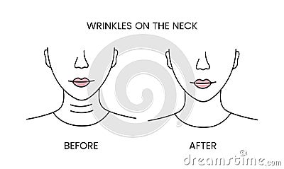 Wrinkles on the neck, laser cosmetology before procedure and after applying treatment line icon in vector. Illustration Vector Illustration
