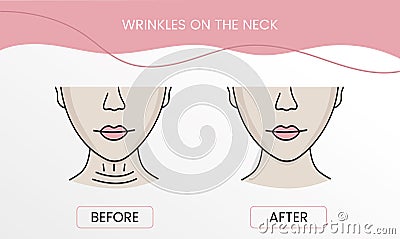 Wrinkles on the neck, laser cosmetology before procedure and after applying treatment in vector. Illustration of a woman Vector Illustration