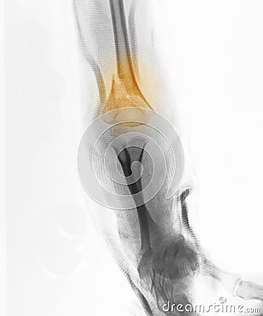 X-ray, 4 year old boy, fracture of distal humerus Stock Photo