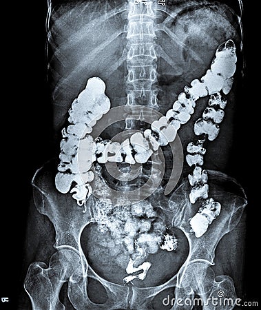 X Ray of Abdomen with large intestine. Stock Photo