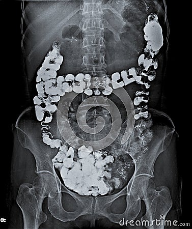 X Ray of Abdomen with large intestine. Stock Photo