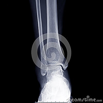 X-ray ankle joint or Radiographic image or x-ray image of right ankle joint Stock Photo