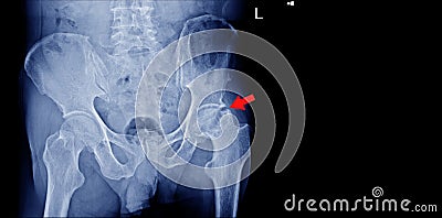 X-Ray Both Hips No fracture and dislocation ,Normal joint space finding Aseptic necrosis.on red arrow point Stock Photo