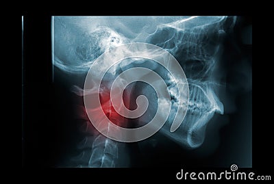 X-ray of the cervical spine with painful area. Film x-ray c-spine (Lateral view) : Cervical level spine. Stock Photo