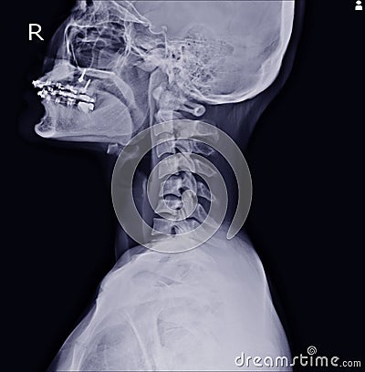 X-ray of the cervical spine showing Thoracic scoliosis with cervical spondylosis from C4-5 to C7-T1 Stock Photo