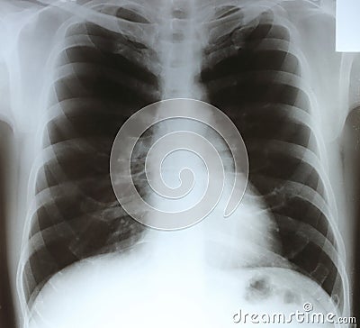 X-ray chest film Stock Photo