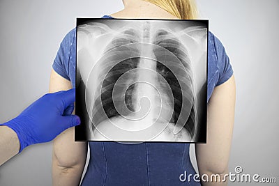 X-ray of the chest of a woman. A doctor radiologist is studying an x-ray examination. A picture of the organs of the chest cavity Stock Photo