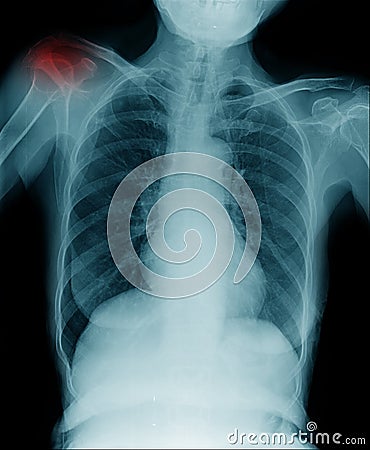X-ray clavicle fracture Stock Photo