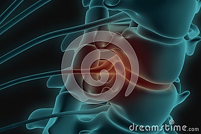 X-ray 3d image of cervical spine with prolapse of intervertebral disc compressive nerve root Stock Photo