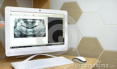 X-ray in dentistry snapshot of a tooth. computer monitor Stock Photo