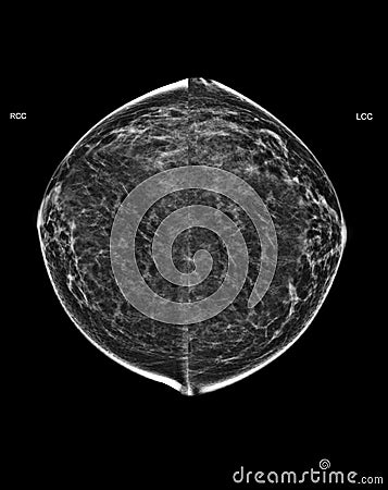 X-ray Digital Mammogram or mammography of both side breast Standard views are bilateral craniocaudal (CC Stock Photo