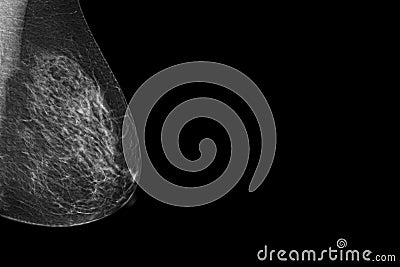 X-ray Digital Mammogram or mammography image MLO view for screening Breast cancer. Stock Photo