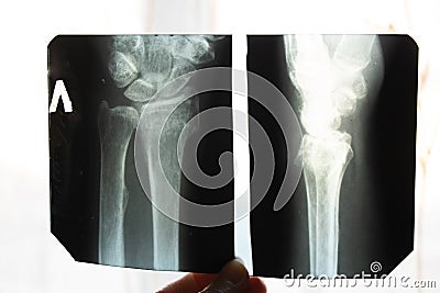 X-ray of an elderly person with osteoporosis and arthritis arthrosis, bone destruction Stock Photo