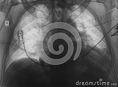 X-ray examination of patient after cardiac surgery Stock Photo
