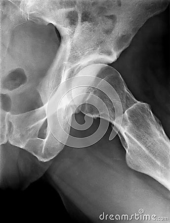 X-Ray of female Left Hip. Stock Photo