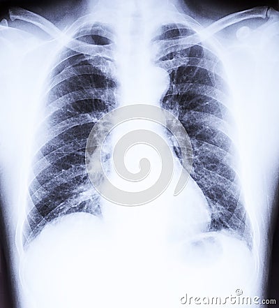 X-Ray film dislocation of Shoulder Stock Photo