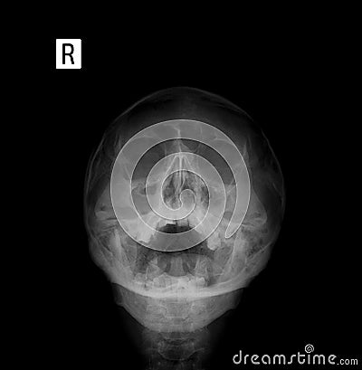 X-ray film of the face - frontal, nose-chin projection. Sinusitis. Stock Photo