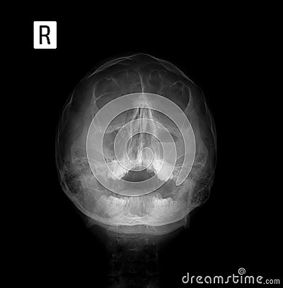 X-ray film of the face - frontal, nose-chin projection. Sinusitis. Stock Photo