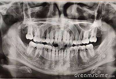 X ray film of human mouth with healthy teeth. Detail of panoramic facial x-ray image Stock Photo